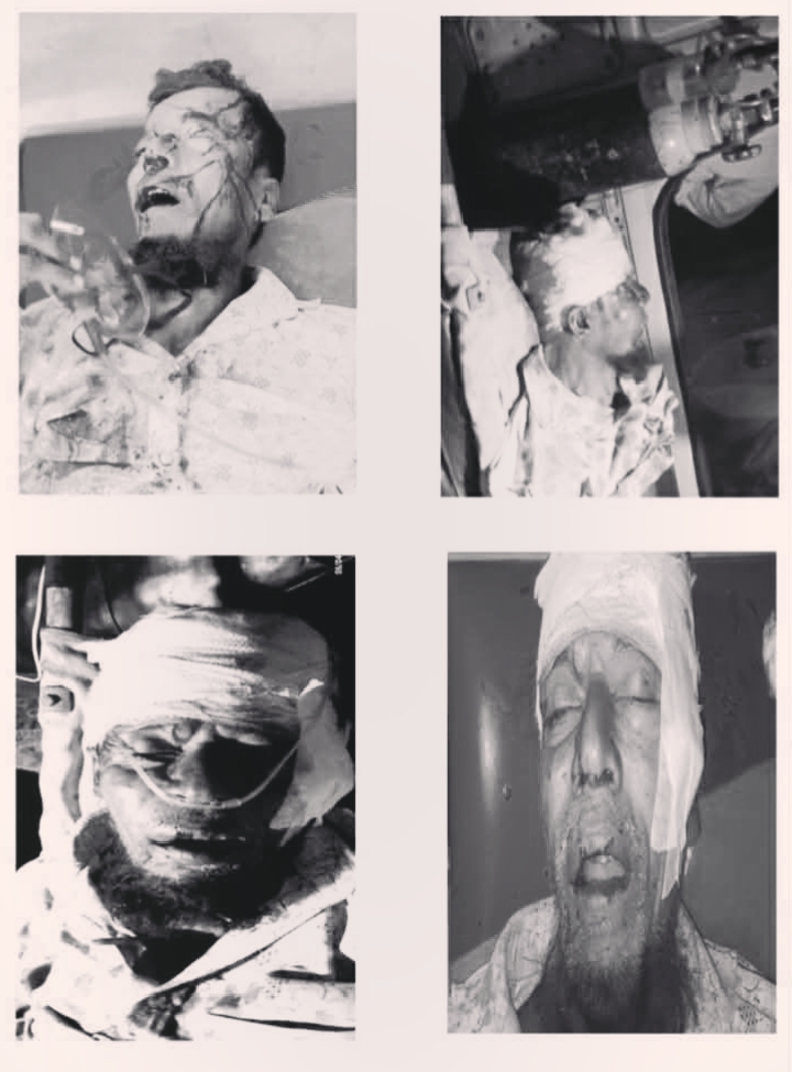 গলাচিপায় জমি-জমা বিরোধের জেরে কৃষক এর উপর হামলা।মৃত্যুর সাথে পাঞ্জা লড়ছে কৃষক !